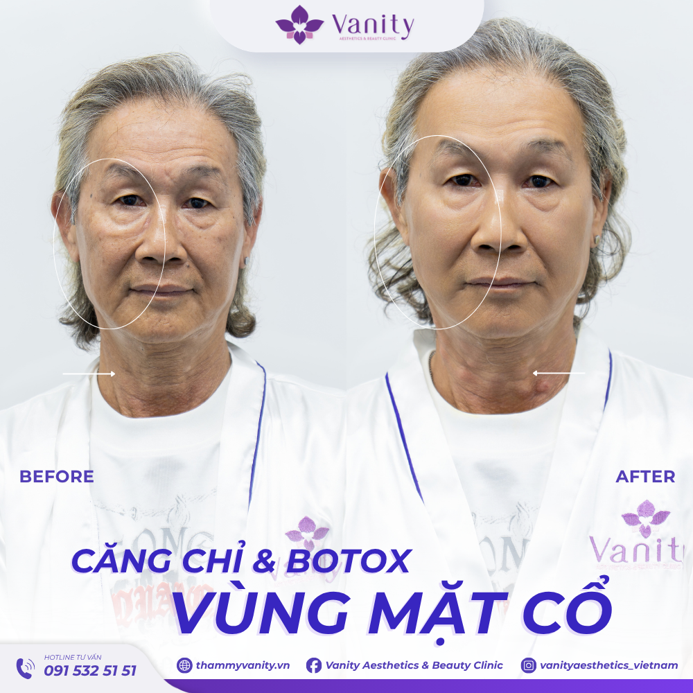 CĂNG CHỈ & BOTOX VÙNG MẶT CỔ